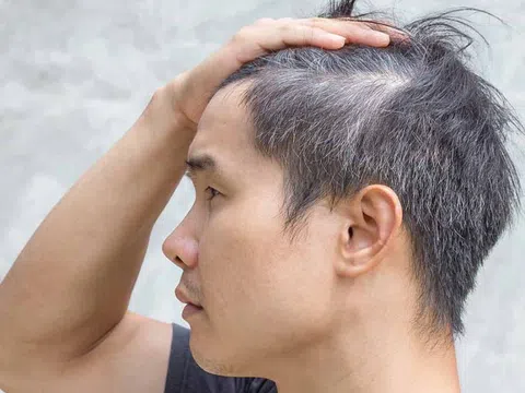 7 nguyên nhân khiến người trẻ có tóc bạc